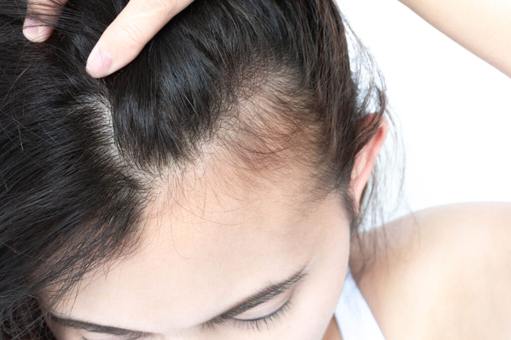 Hoe ontstaan haargroeistoornissen en haaruitval en hoe komt u er vanaf?